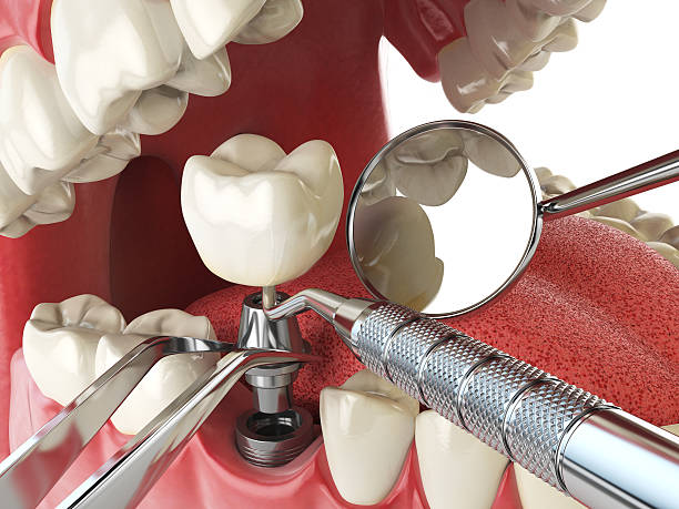 Best Emergency Tooth Extraction in Beach City, TX